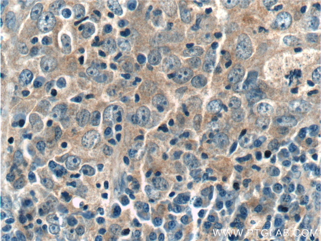IHC staining of human breast cancer using 24080-1-AP