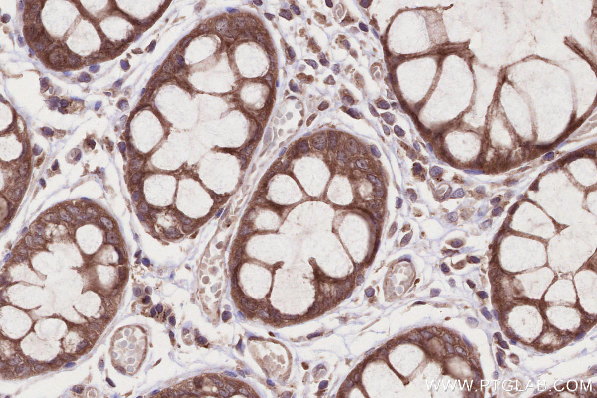 IHC staining of human rectal cancer using 24283-1-AP