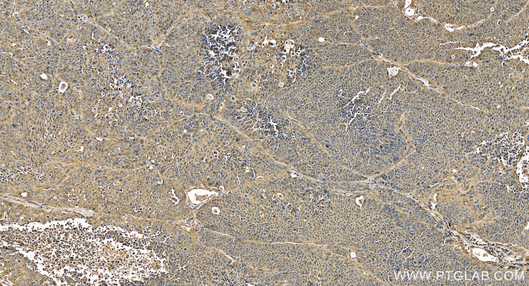 IHC staining of human lung cancer using 84210-4-RR (same clone as 84210-4-PBS)