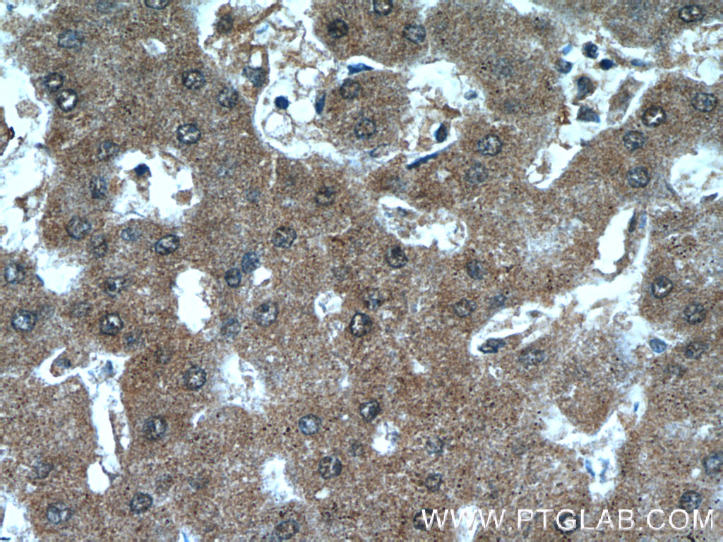 IHC staining of human hepatocirrhosis using 24058-1-AP