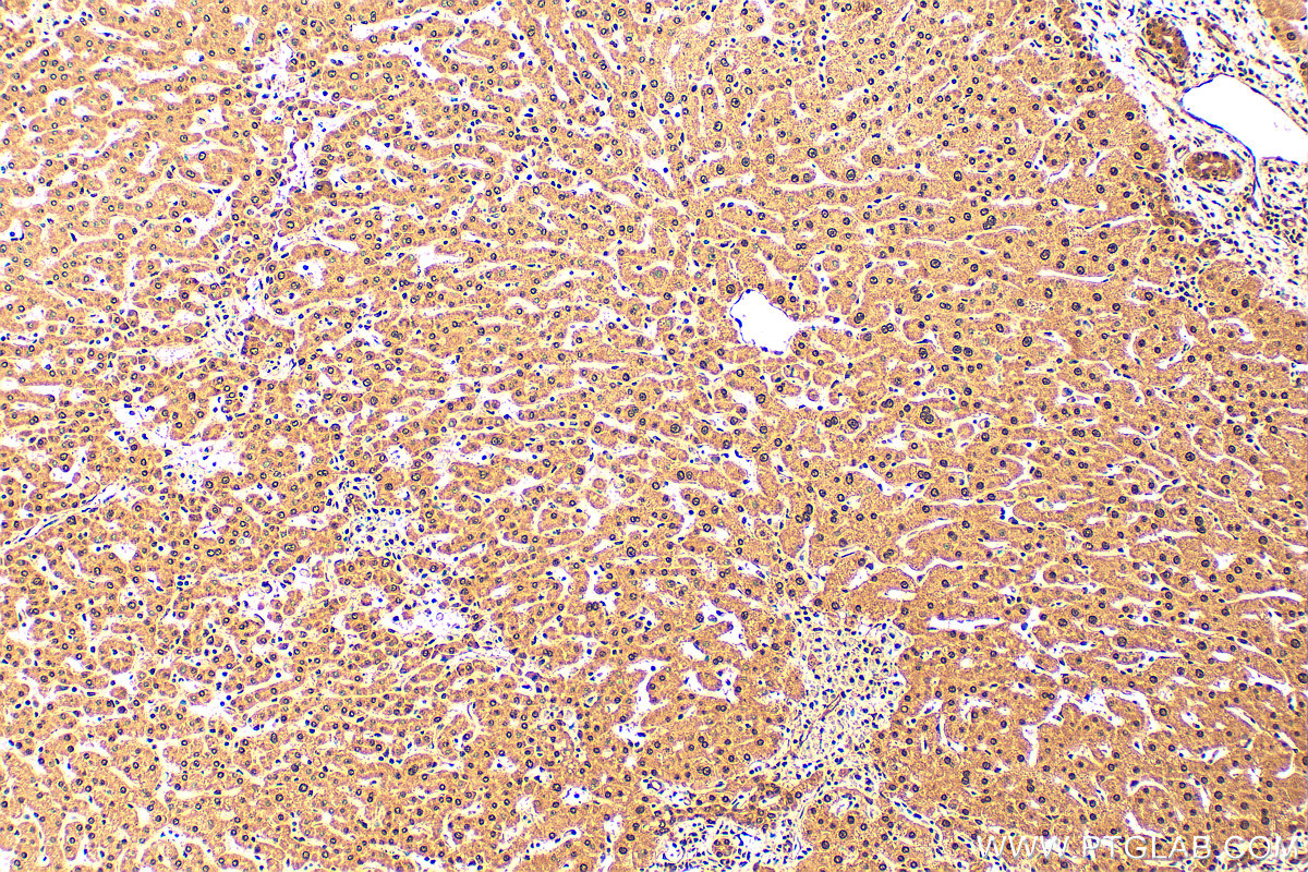 IHC staining of human hepatocirrhosis using 24058-1-AP