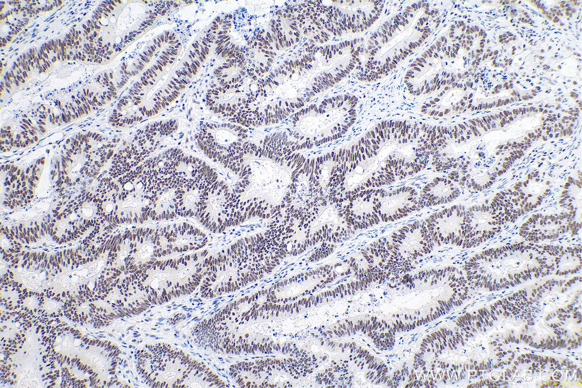 IHC staining of human colon cancer using 66160-1-Ig