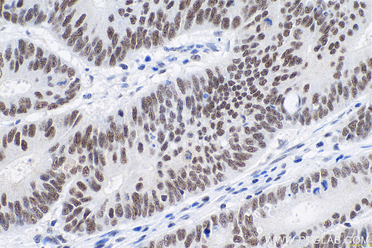 IHC staining of human colon cancer using 66160-1-Ig