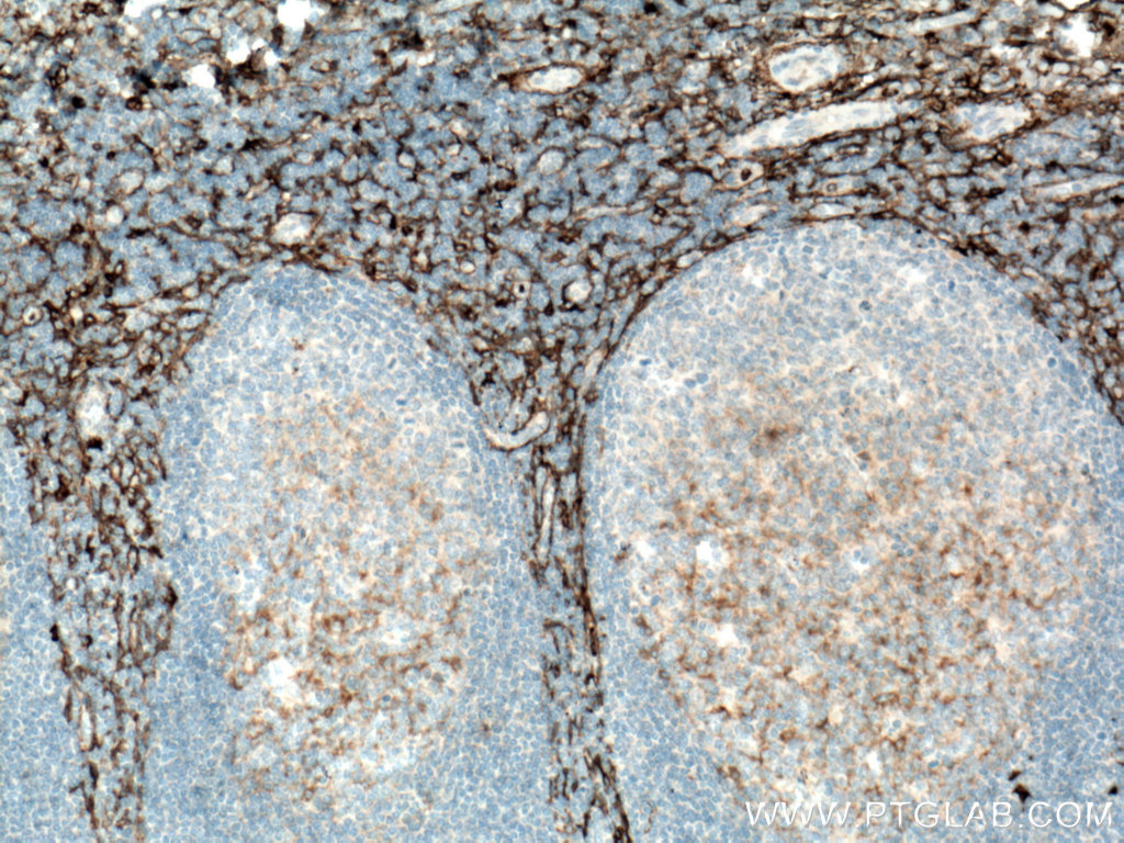 IHC staining of human tonsillitis using 14553-1-AP