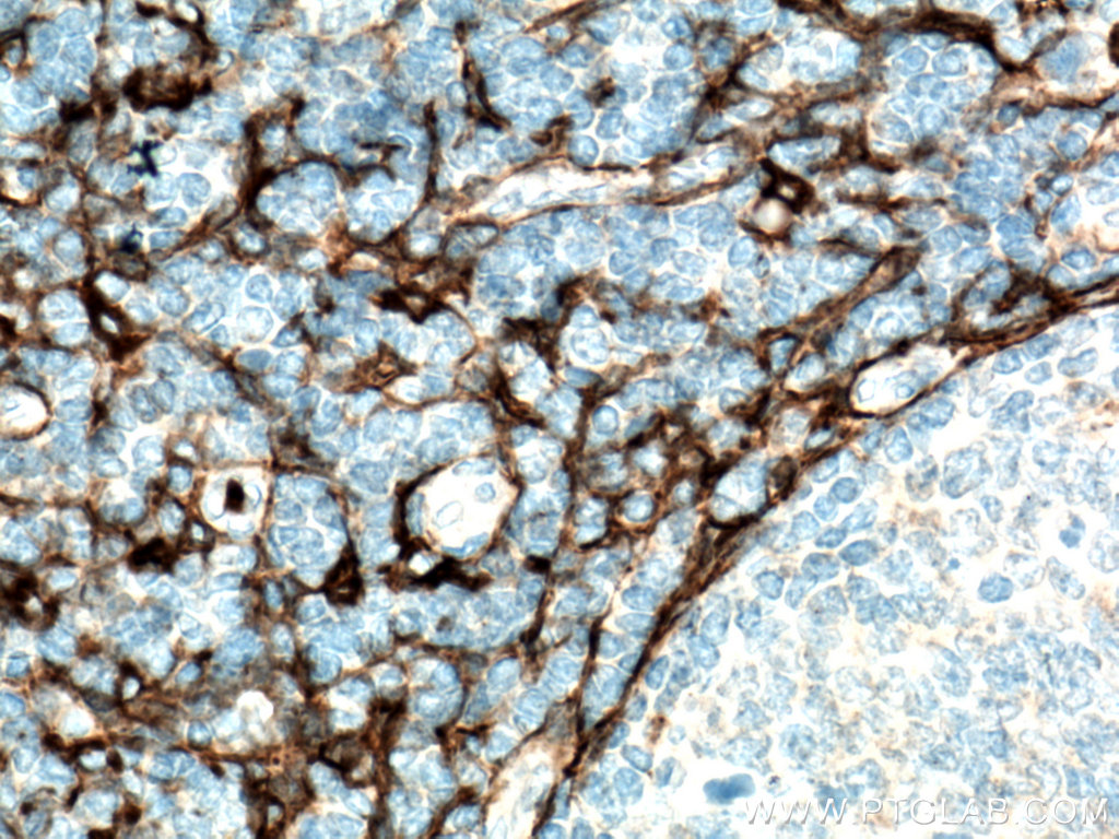 IHC staining of human tonsillitis using 14553-1-AP