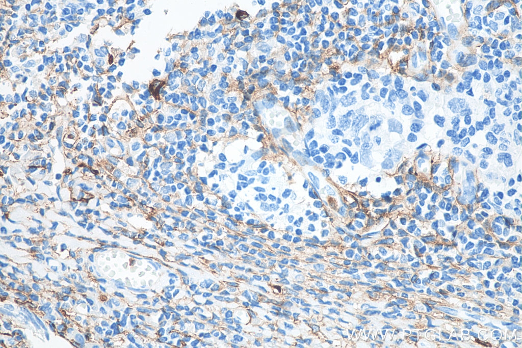 IHC staining of human tonsillitis using 66211-1-Ig