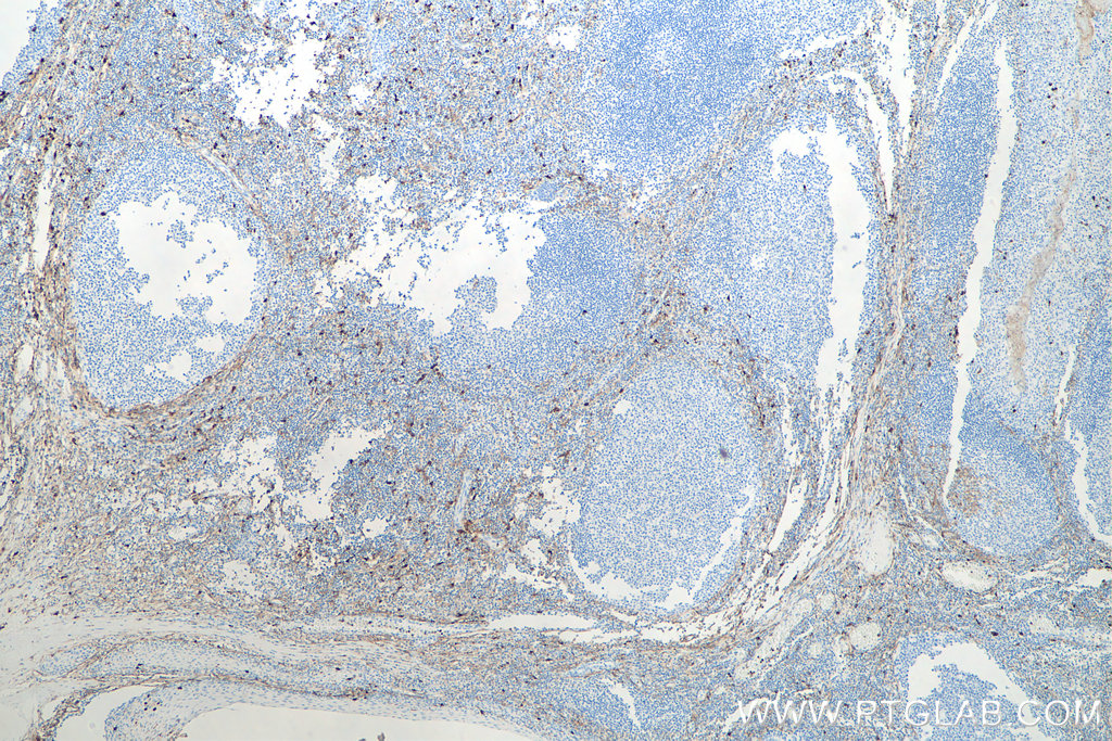 IHC staining of human tonsillitis using 66211-1-Ig