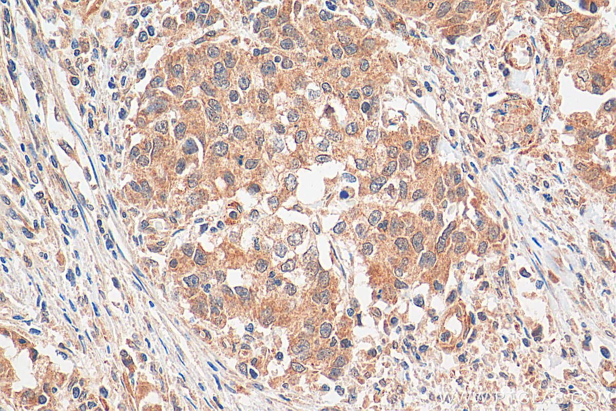 IHC staining of human stomach cancer using 17478-1-AP