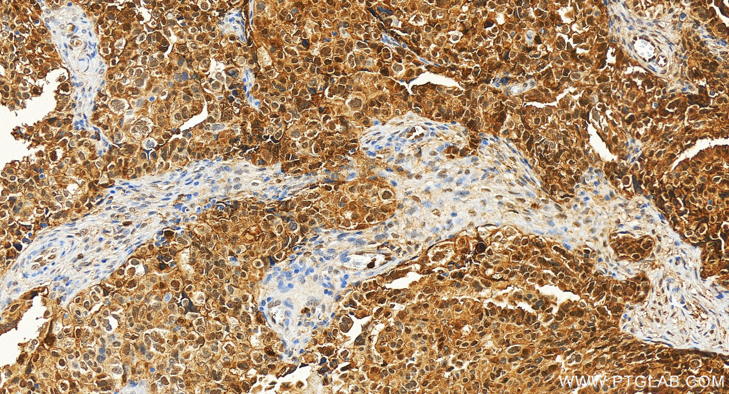 IHC staining of human ovary cancer using 21990-1-AP