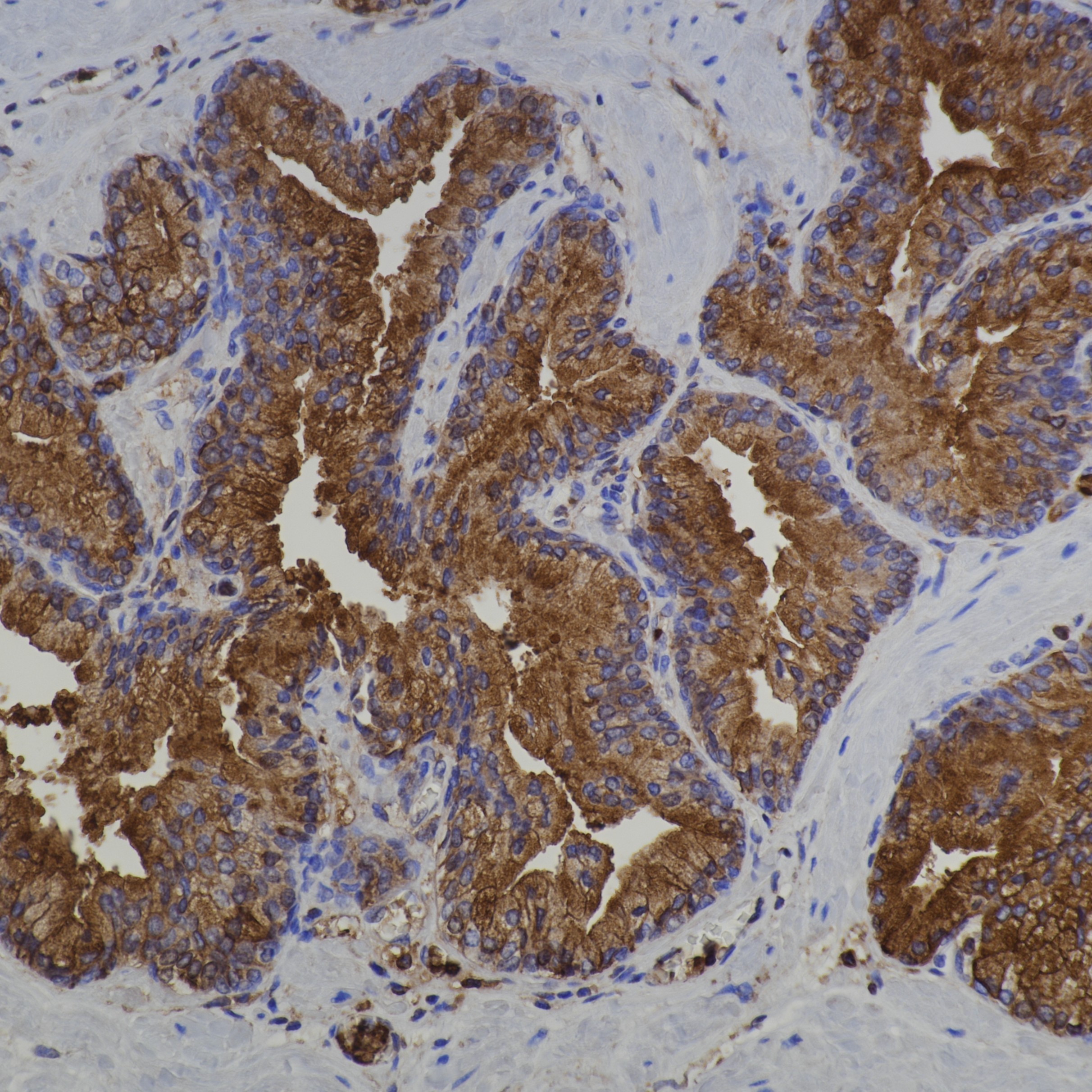 IHC staining of human prostate using 66344-1-Ig IHC staining of human prostate using 66344-1-Ig