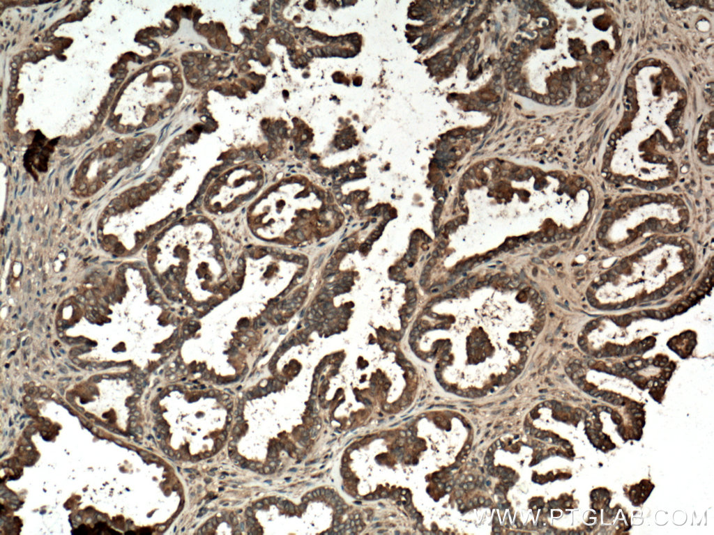 IHC staining of human ovary tumor using 10479-2-AP