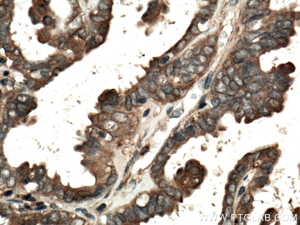 IHC staining of human ovary tumor using 10479-2-AP