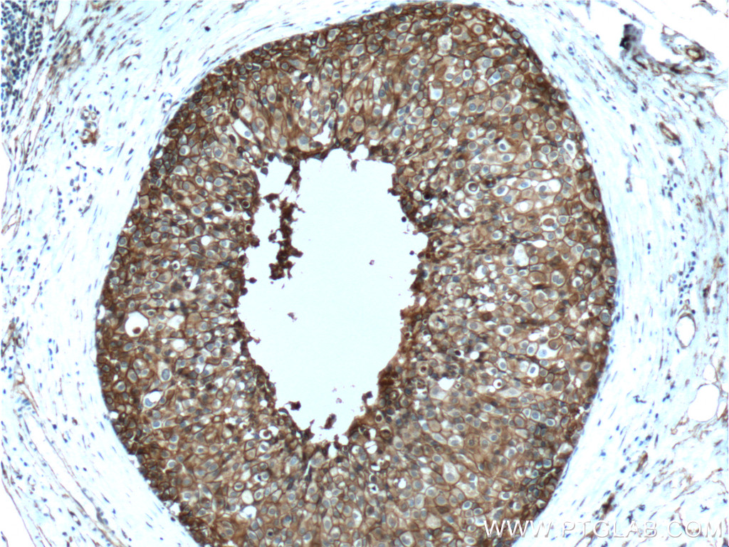 IHC staining of human breast cancer using 60051-1-Ig