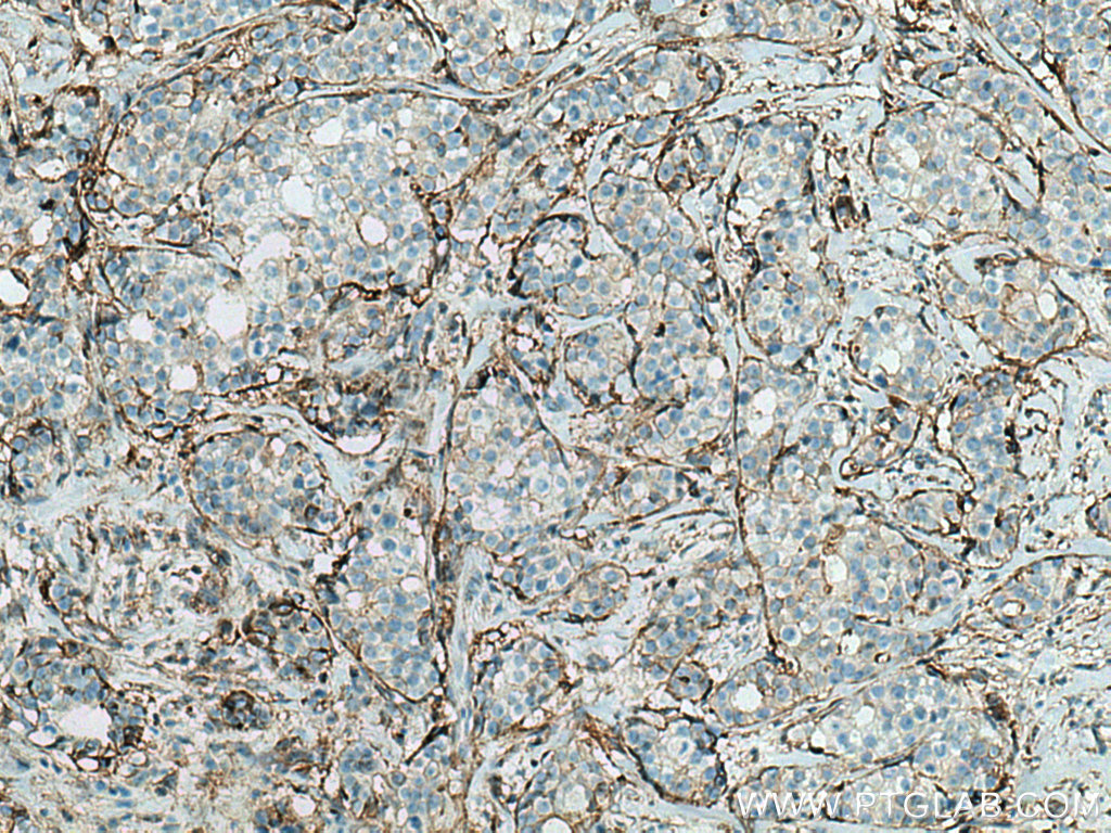 IHC staining of human breast cancer using 66035-1-Ig