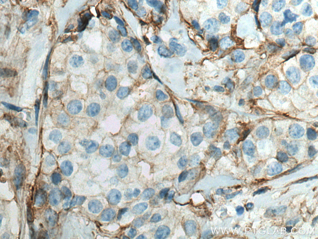 IHC staining of human breast cancer using 66035-1-Ig