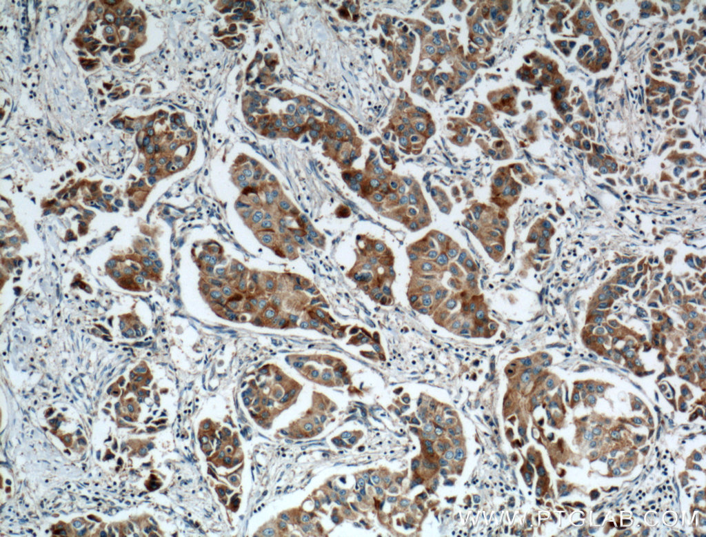 IHC staining of human breast cancer using 15416-1-AP