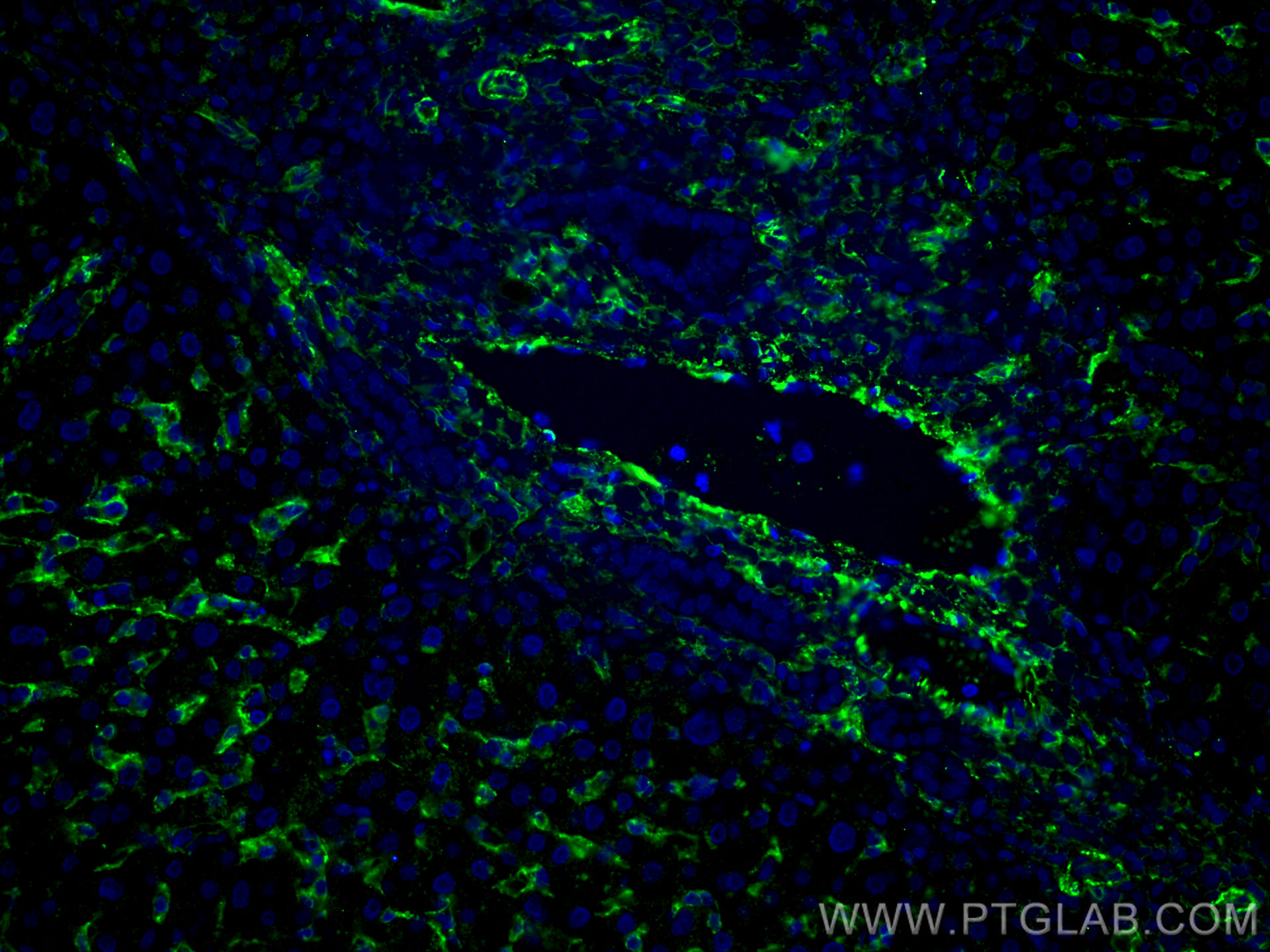 IF Staining of human liver cancer using 66834-1-Ig