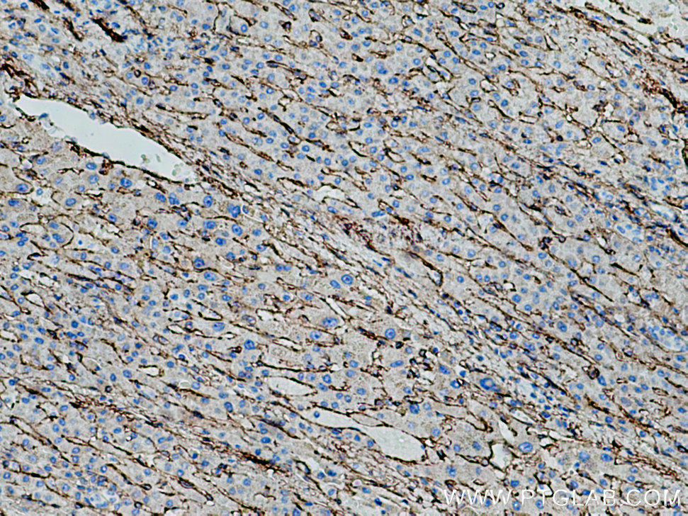 IHC staining of human liver cancer using 66834-1-Ig