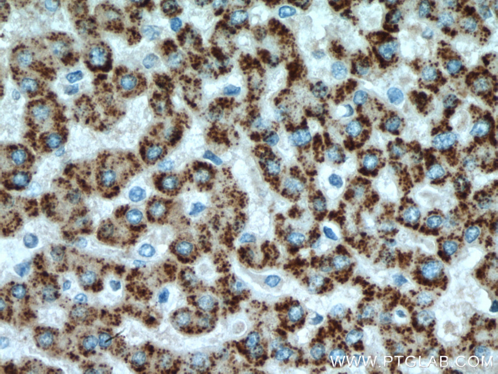 IHC staining of human liver cancer using 10957-1-AP