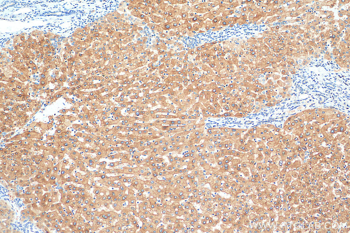 IHC staining of human hepatocirrhosis using 19495-1-AP