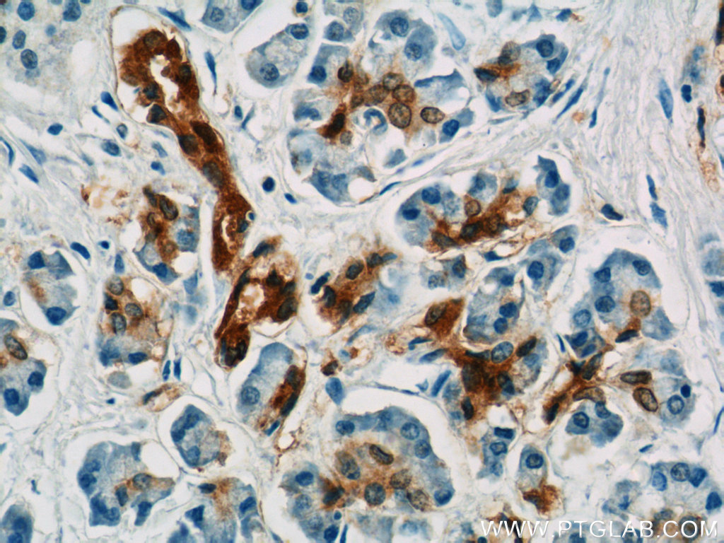 IHC staining of human pancreas cancer using 13258-1-AP