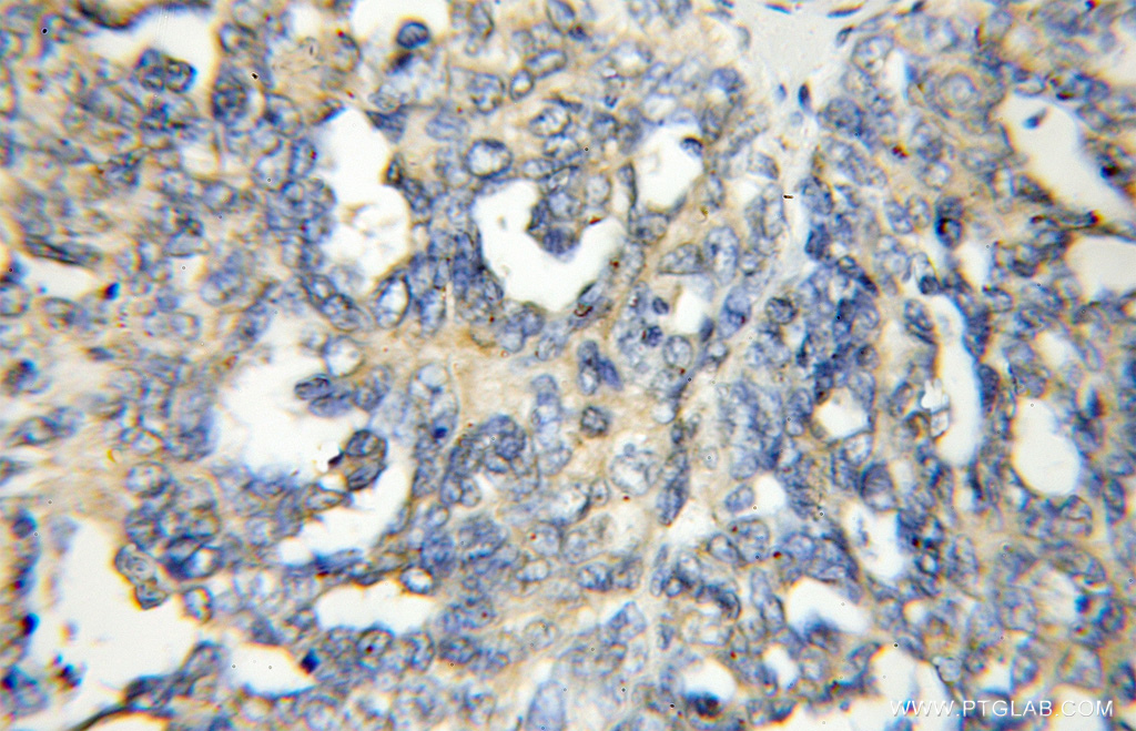 IHC staining of human ovary tumor using 11401-1-AP