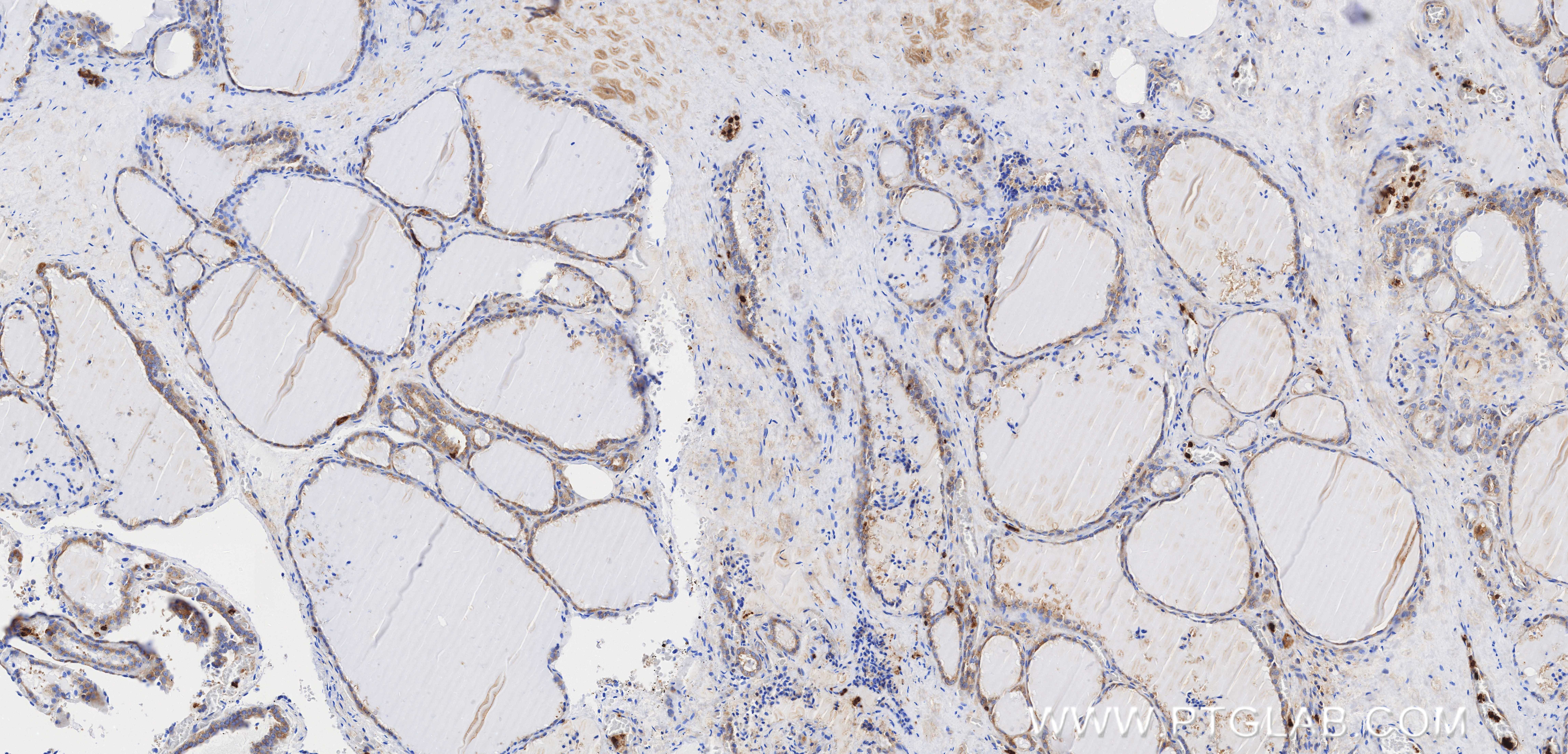 IHC staining of human thyroid using 84174-3-RR