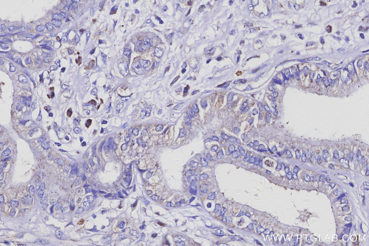 IHC staining of human pancreas cancer using 13384-1-AP