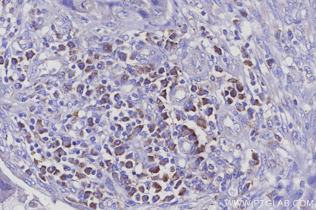 IHC staining of human pancreas cancer using 13384-1-AP