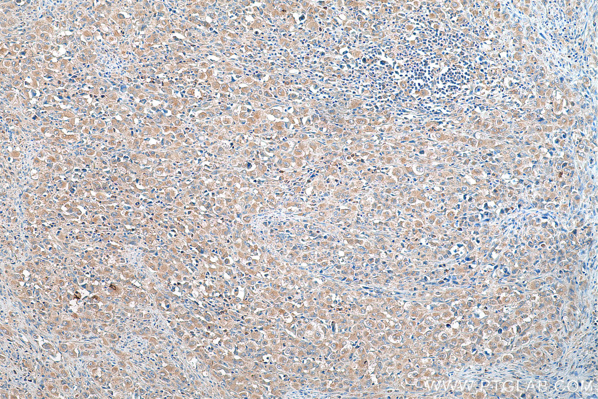 IHC staining of human lymphoma using 11653-1-AP