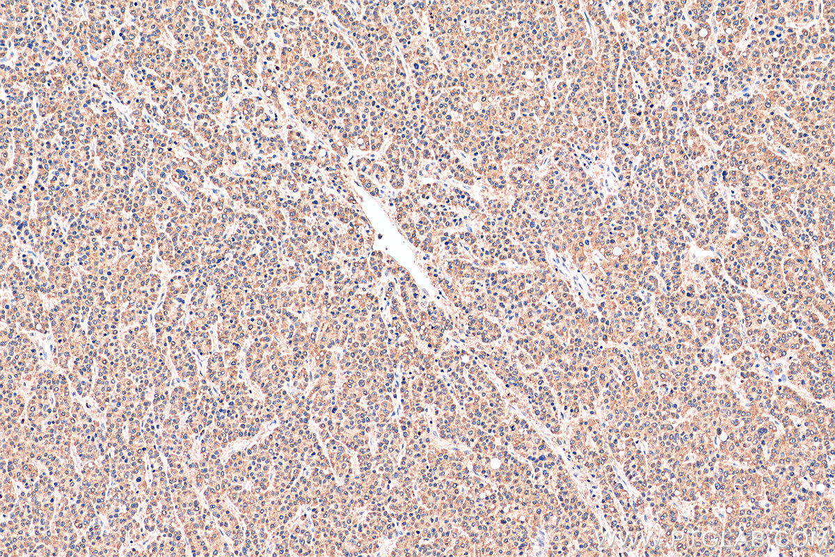 IHC staining of human liver cancer using 66533-1-Ig