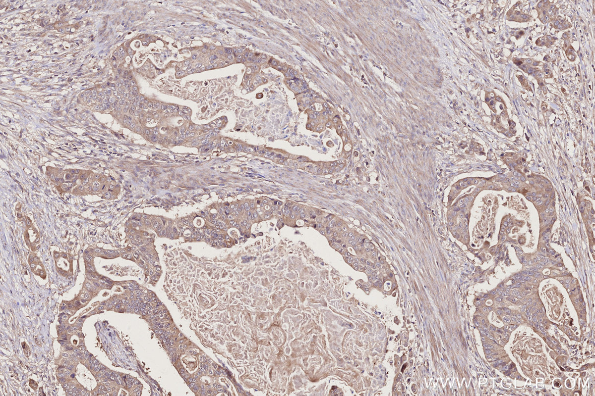 IHC staining of human stomach cancer using 13177-1-AP