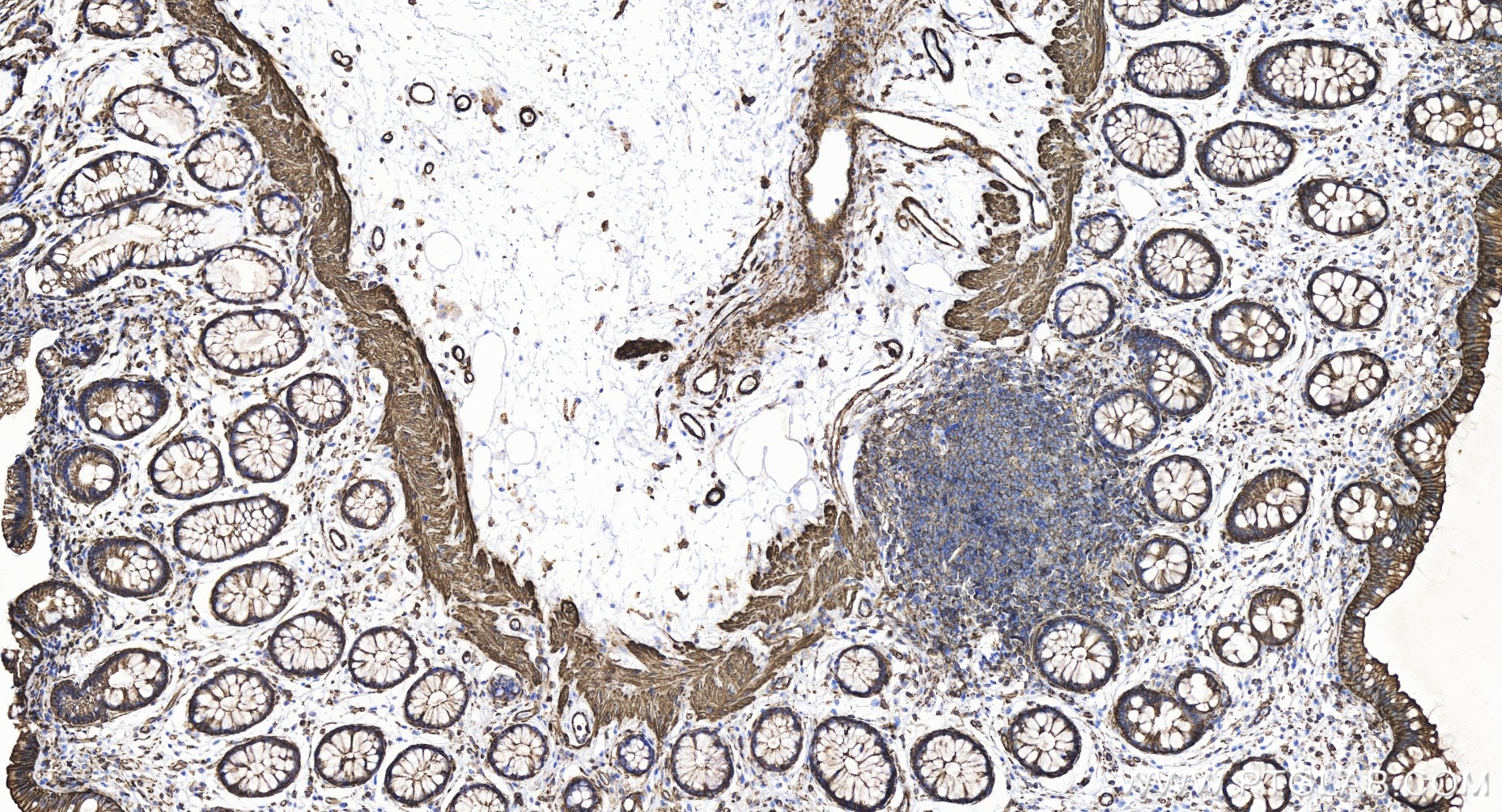 IHC staining of human colon using 85372-1-RR