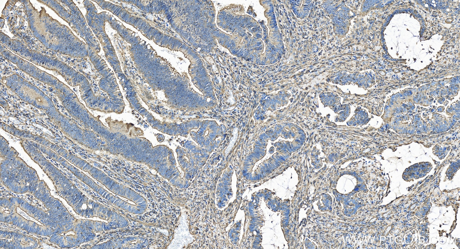 IHC staining of human colon cancer using 85372-1-RR
