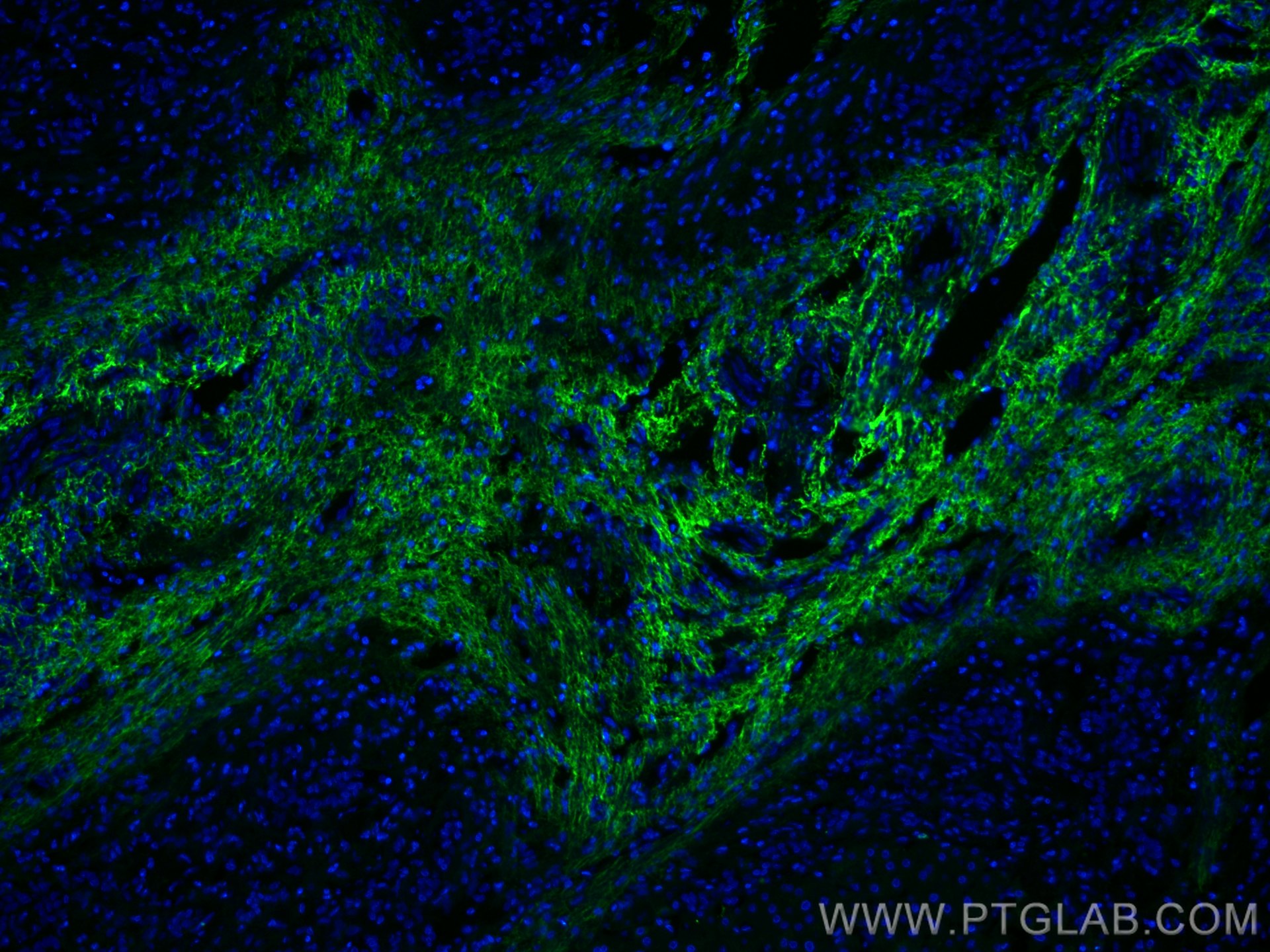 IF Staining of human liver cancer using 66084-1-Ig