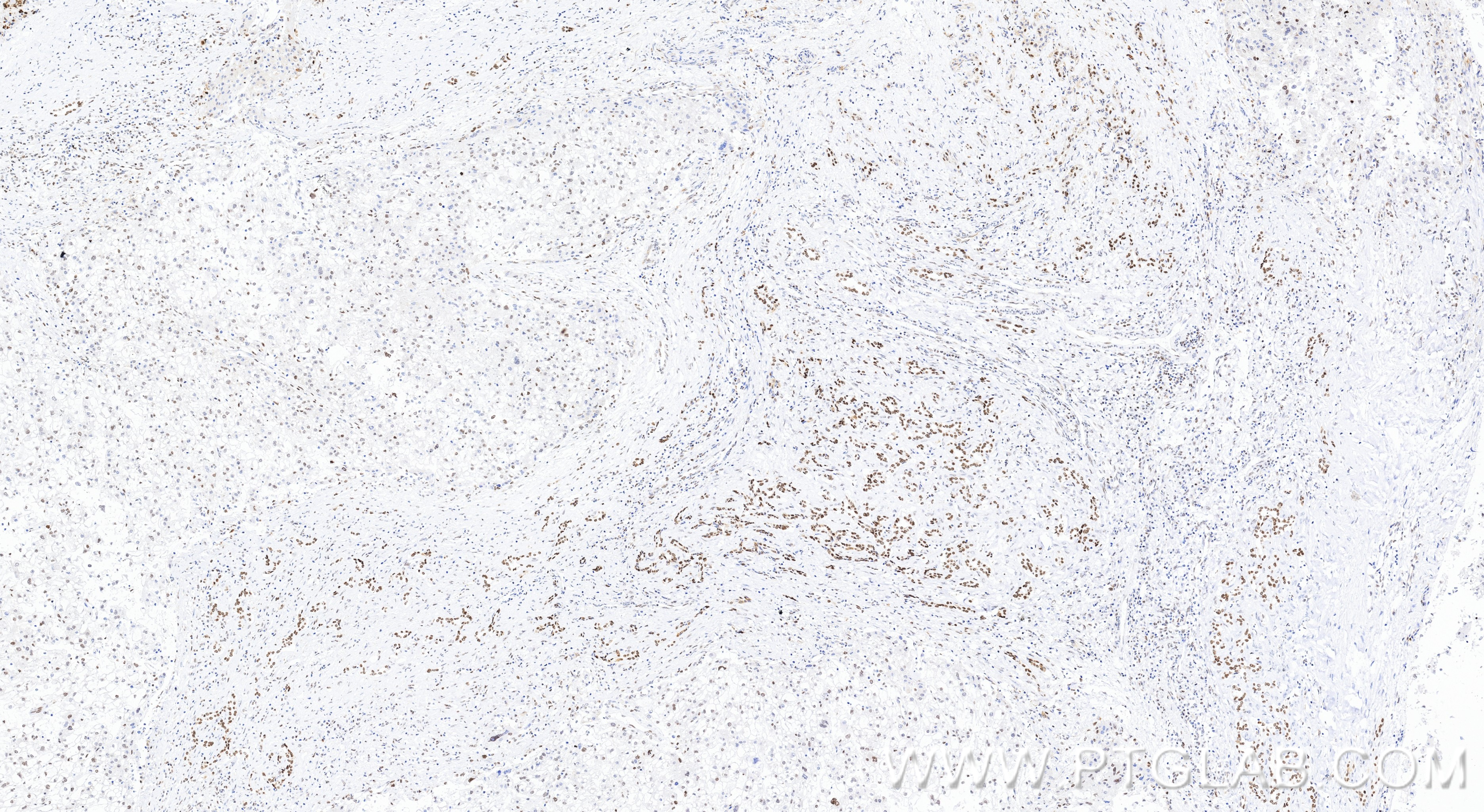 IHC staining of human liver cancer using 86719-1-RR (same clone as 86719-1-PBS) IHC staining of human liver cancer using 86719-1-RR (same clone as 86719-1-PBS)