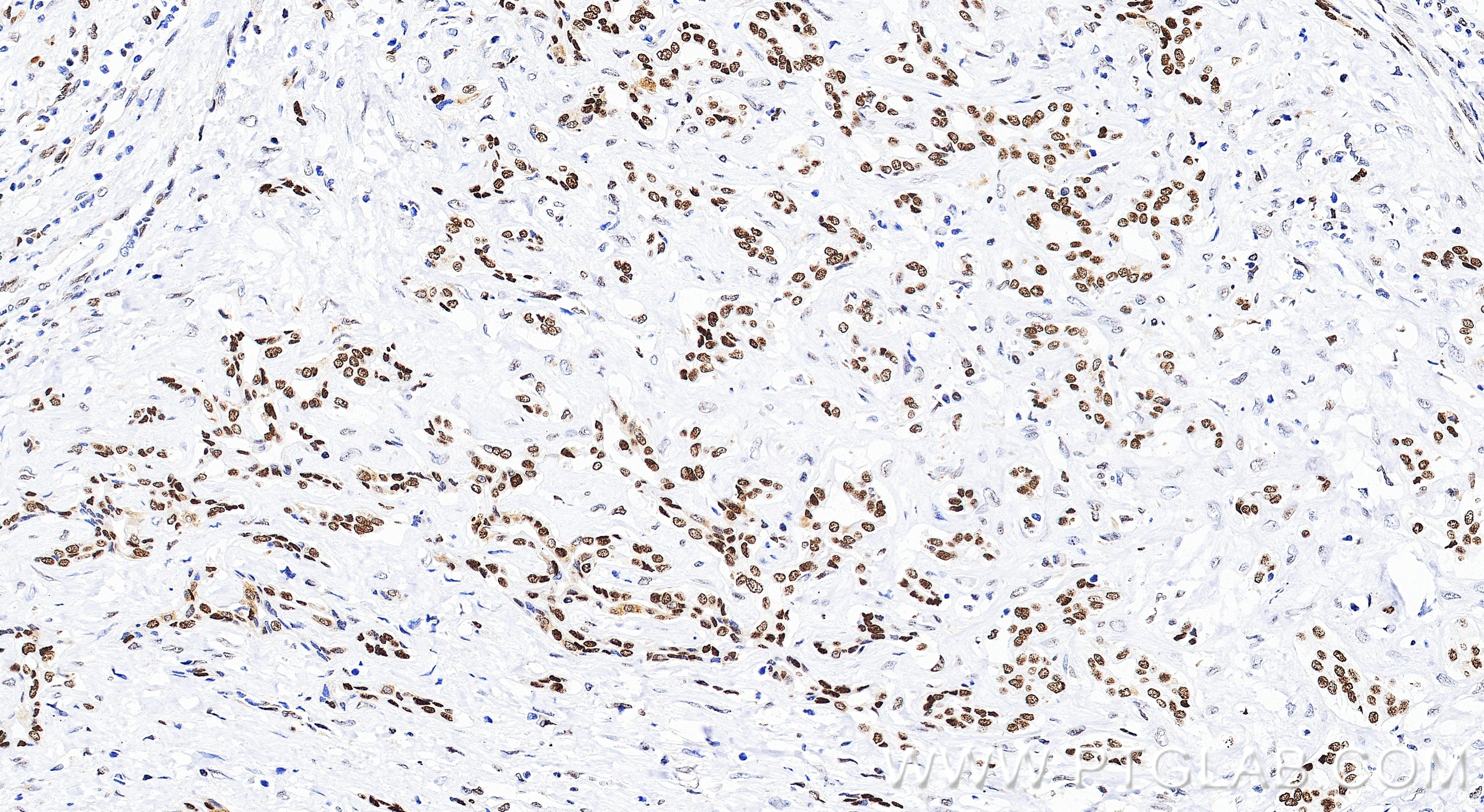 IHC staining of human liver cancer using 86719-1-RR (same clone as 86719-1-PBS) IHC staining of human liver cancer using 86719-1-RR (same clone as 86719-1-PBS)