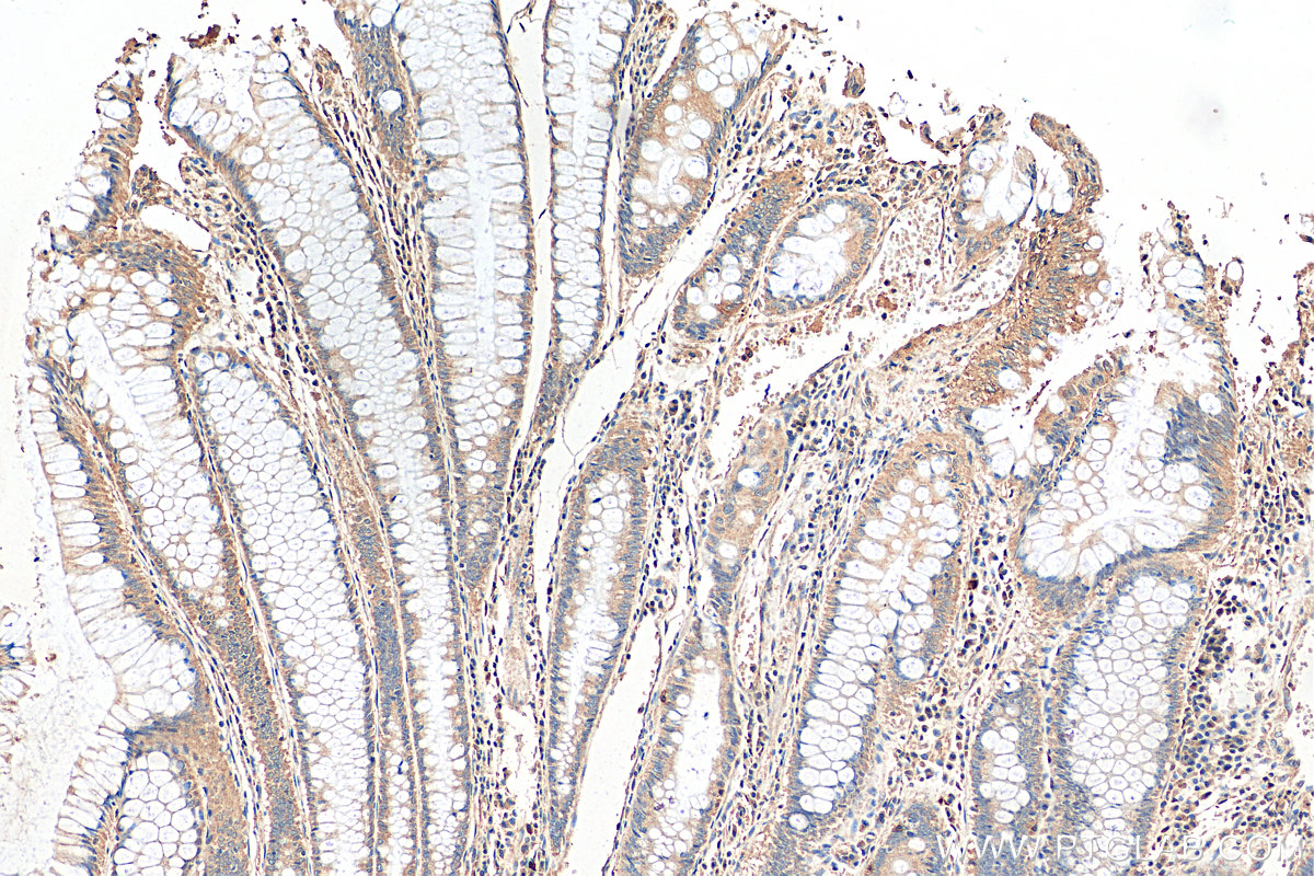 IHC staining of human colon cancer using 11497-1-AP
