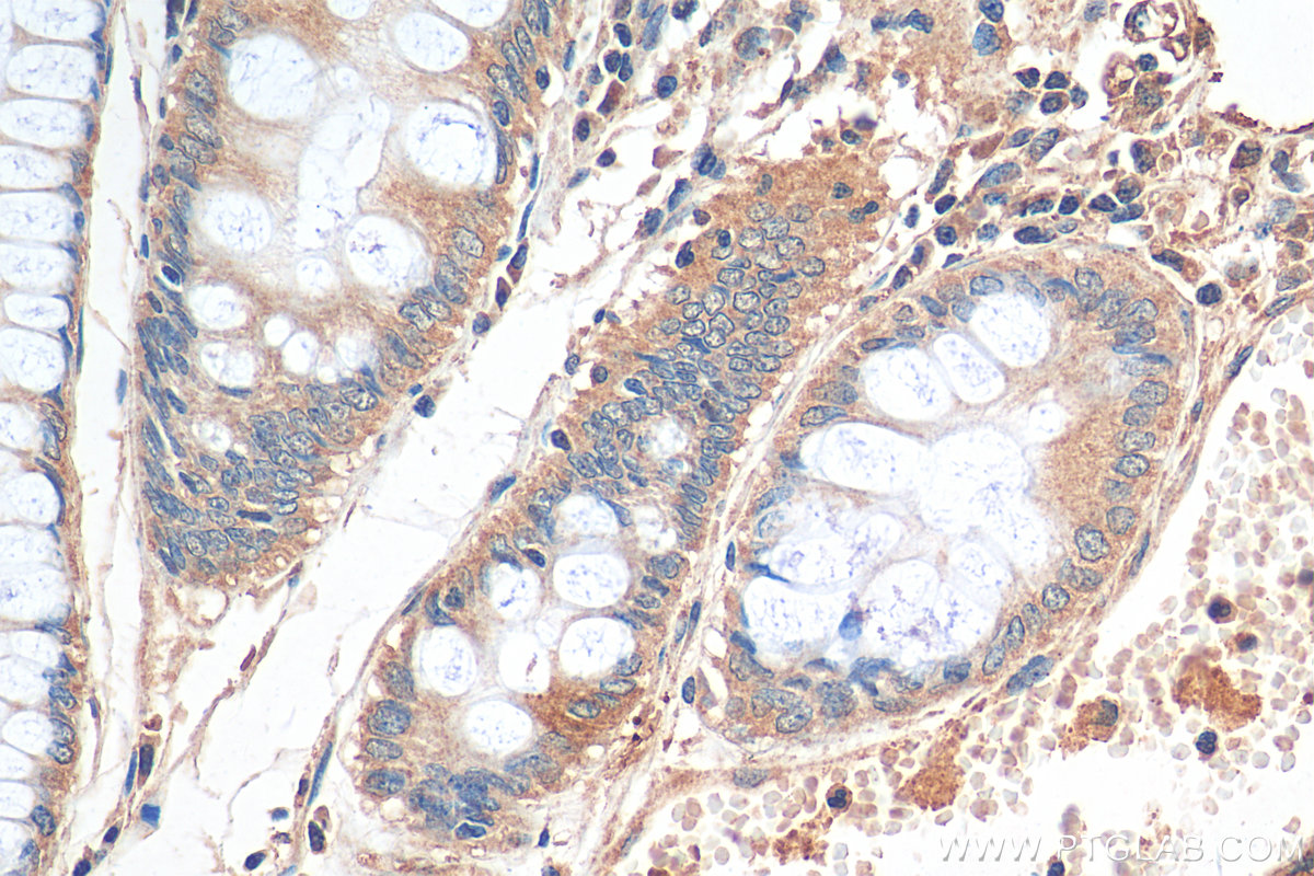 IHC staining of human colon cancer using 11497-1-AP