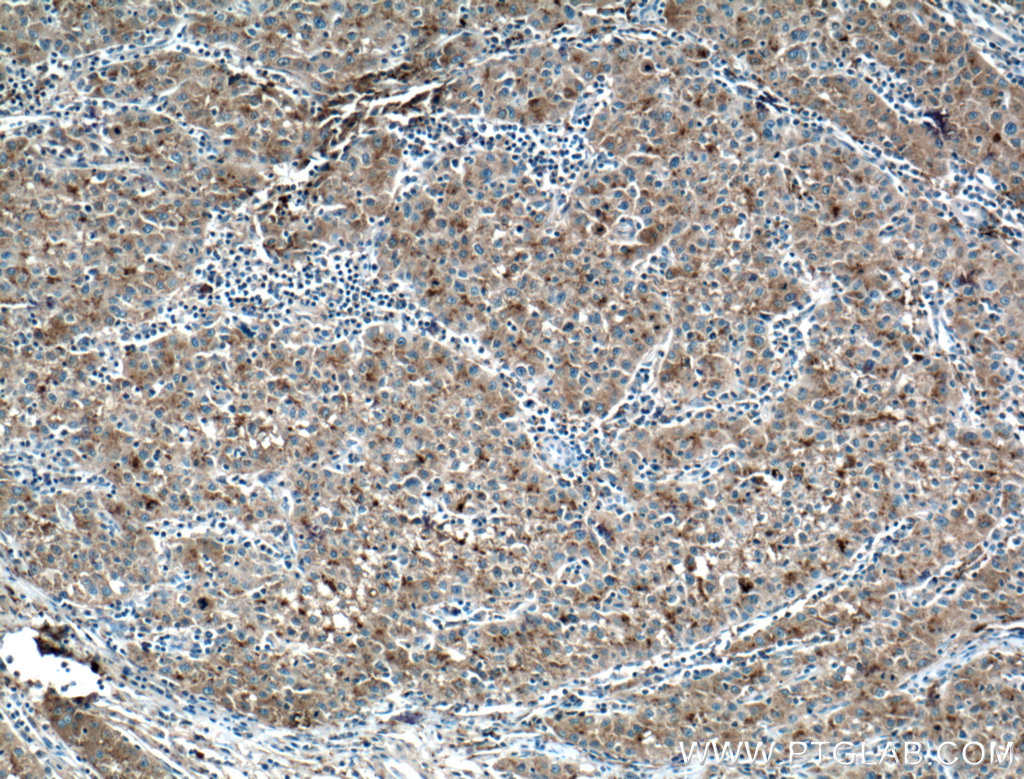 IHC staining of human liver cancer using 14427-1-AP