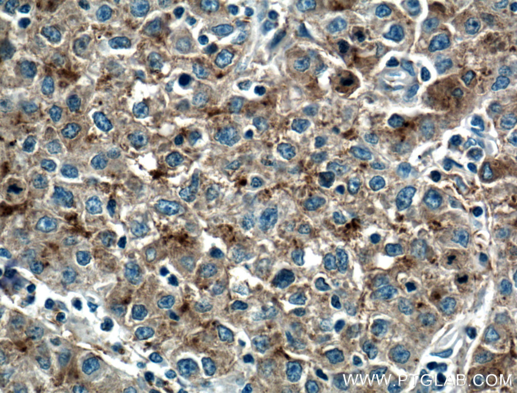 IHC staining of human liver cancer using 14427-1-AP