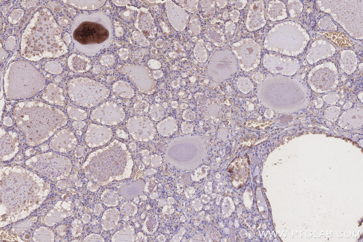 IHC staining of human thyroid cancer using 66252-1-Ig
