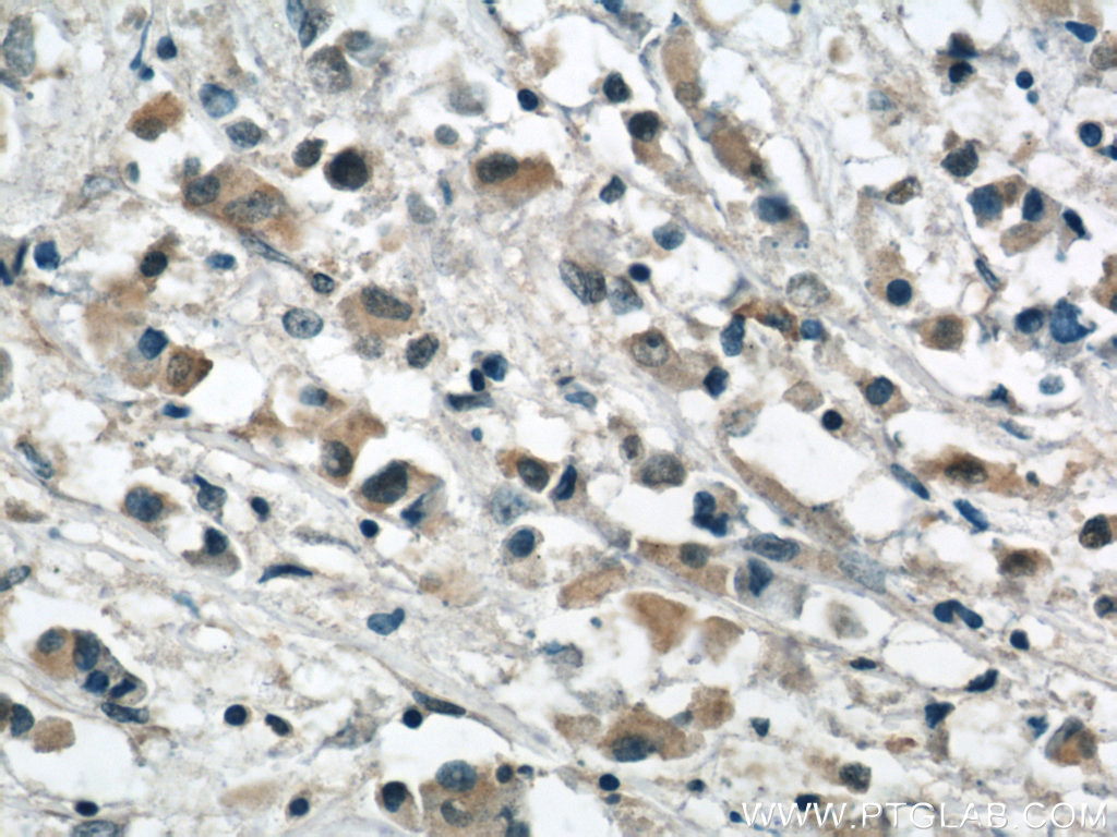 IHC staining of human breast cancer using 60100-1-Ig