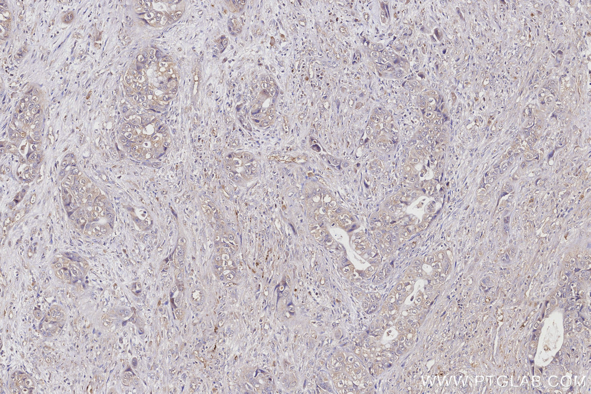 Immunohistochemical analysis of paraffin-embedded human pancreas cancer tissue slide using 66830-1-Ig (APOE antibody) at dilution of 1:1000 (under 10x lens). Heat mediated antigen retrieval with Tris-EDTA buffer (pH 9.0). IHC staining of human pancreas cancer using 66830-1-Ig