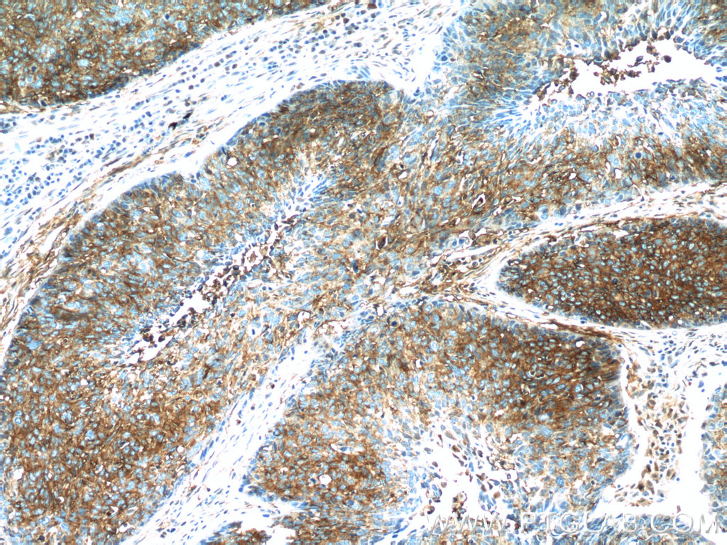 IHC staining of human lung cancer using 25925-1-AP