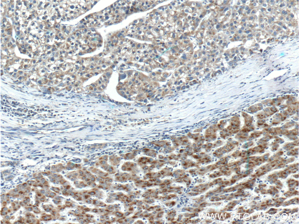 IHC staining of human liver cancer using 10564-1-AP