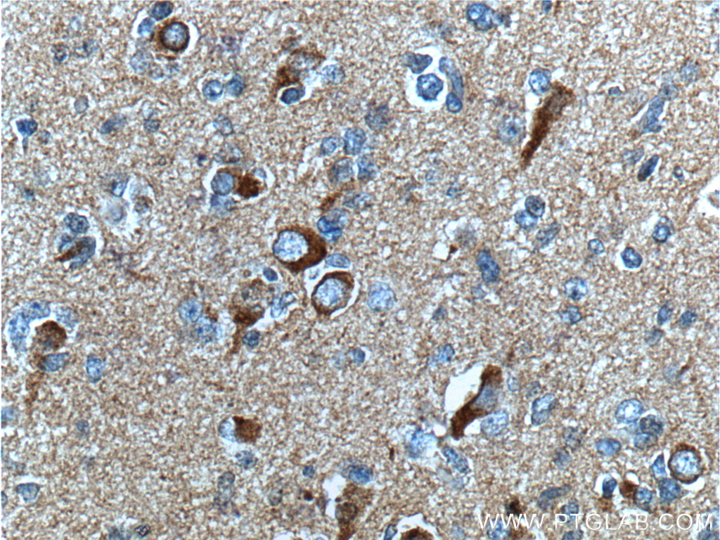 IHC staining of human gliomas using 60342-1-Ig