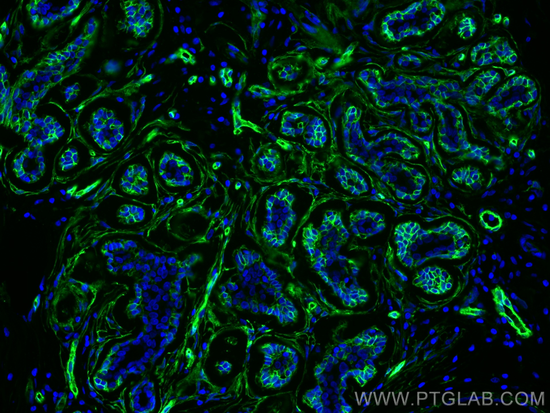 IF Staining of human breast cancer using 20333-1-AP