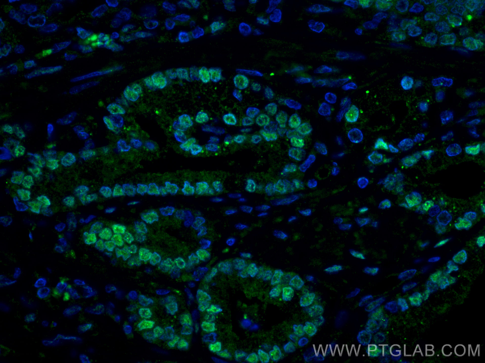 IF Staining of human prostate cancer using 66747-1-Ig
