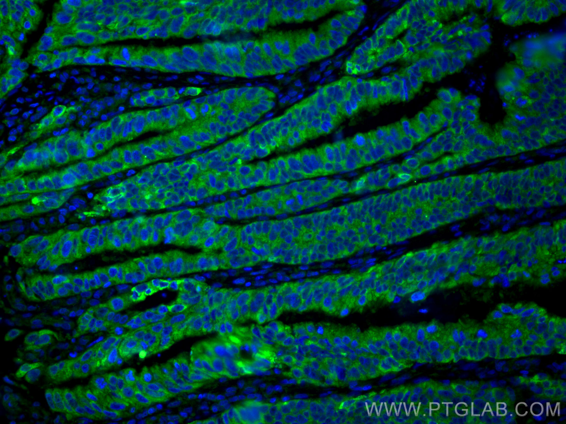 IF Staining of human colon cancer using 16036-1-AP